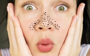 Black dots: What causes them, how you treat them, and what you do