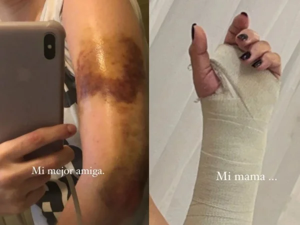 Il a envoyé la fille avec de graves blessures corporelles, c'est ce qui est arrivé à Wanda Naras.