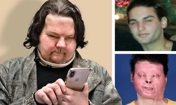 Il primo trapianto di faccia del mondo, il giovane che è stato bruciato due anni fa, con una nuova faccia.