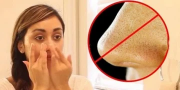 Remove black dots in your face without dermatologist help