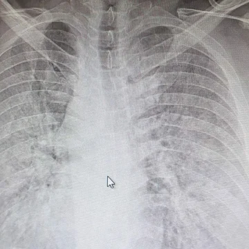 Erfahren Sie mehr über die beste Lunge - Gesundheit Lebensmittel