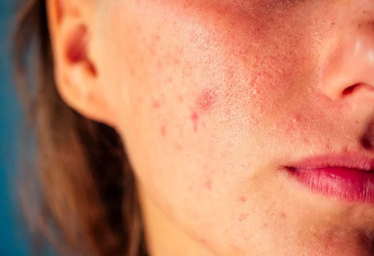From weight gain to acnet; 5 ways in which your body shows hormonal disorders