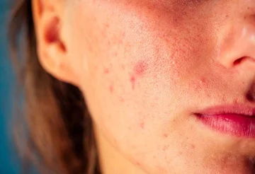 From weight gain to acnet; 5 ways in which your body shows hormonal disorders