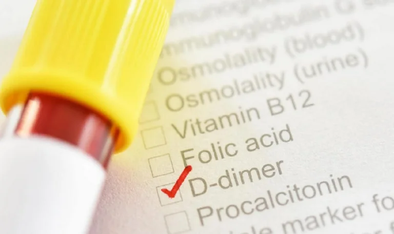 Kosovo doctor talks about D-Dimer analysis: When should you do it, and when should you not?