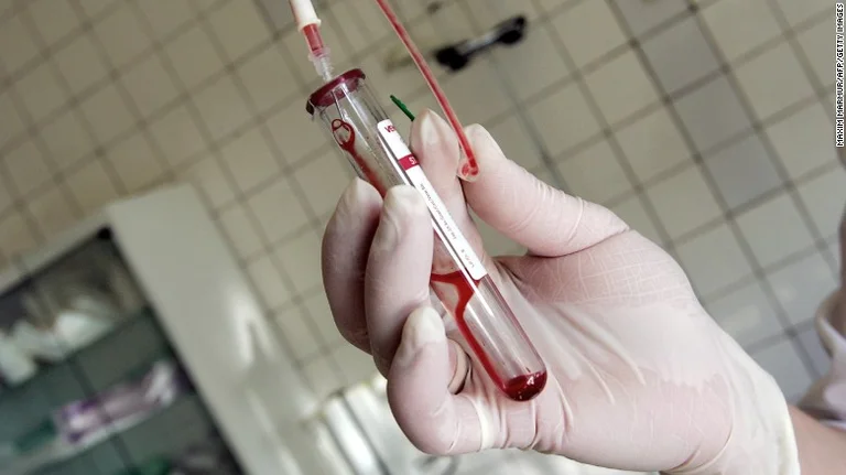 Durante la pandemia il Kosovo non sta facendo test dell'HIV