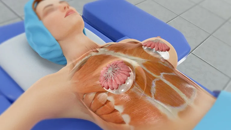 El implante de mama, millones de mujeres lo usan sin conocer la conexión con el tumor raro