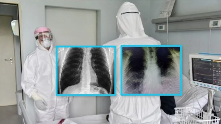 Kosovo doctor publishes Xhatgen photos: That's how it hurts her lungs COVID-19.