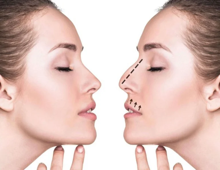 This study shows an interesting new fact about plastic interference in the nose