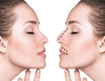 This study shows an interesting new fact about plastic interference in the nose