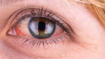 Occhi rossi Warn You of Serious Disease