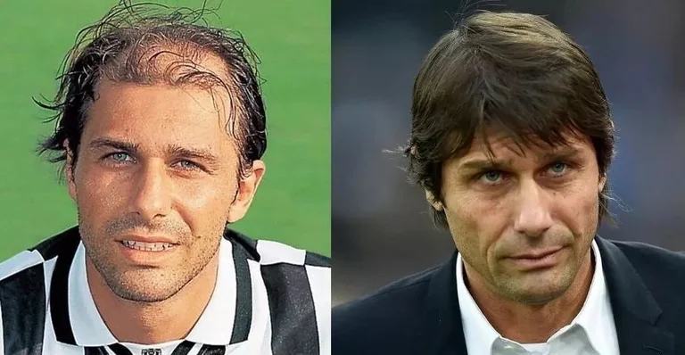 Conte kapet me rivalin: Flokë apo paruke i ke?
