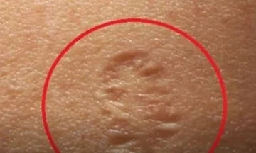 Abbiamo tutti questa piccola cicatrice sul nostro braccio: E' questo che significa.