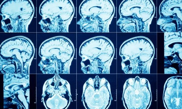 Mënyra e mahnitshme se si koronavirusi arrin të hyjë në tru dhe të shkaktojë çrregullime neurologjike