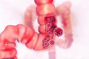 Don't ignore KU THROUGHOUT three signs warn you may be suffering from colon cancer