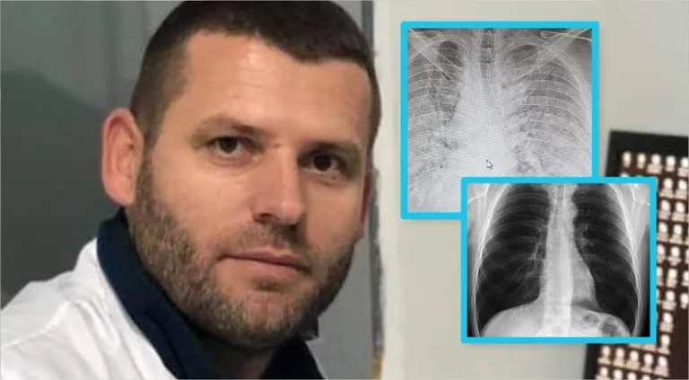 Doktori kosovar publikon pamjet se si Coronavirusi i ka dëmtuar mushkëritë 30 vjeçarit