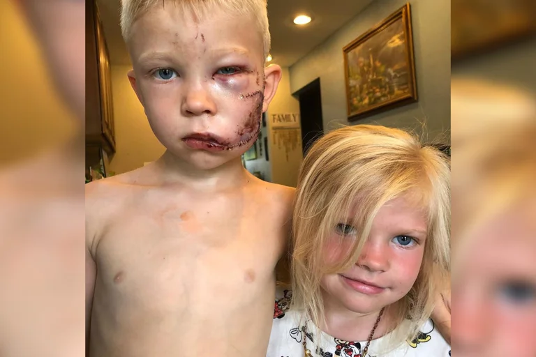 Six-year-old risked his life to save his little sister from brutal dog attack