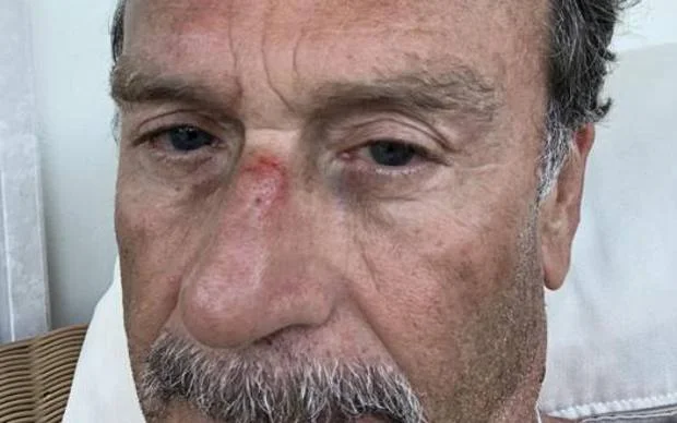 A brutally injured view of the President of Brescia posts photographs with a boxer's face