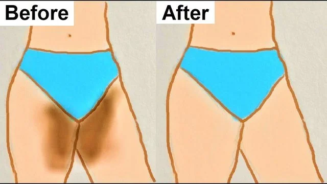 Para se të vishni bikinit e reja, zbardhni lëkurën rreth zonës intime me këto 3 mënyra natyrale