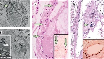 Avid-19 potrebbe essere più di una malattia respiratoria