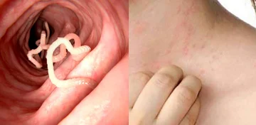 Eliminate the common parasites in your body with these domestic methods, you will be saved forever.