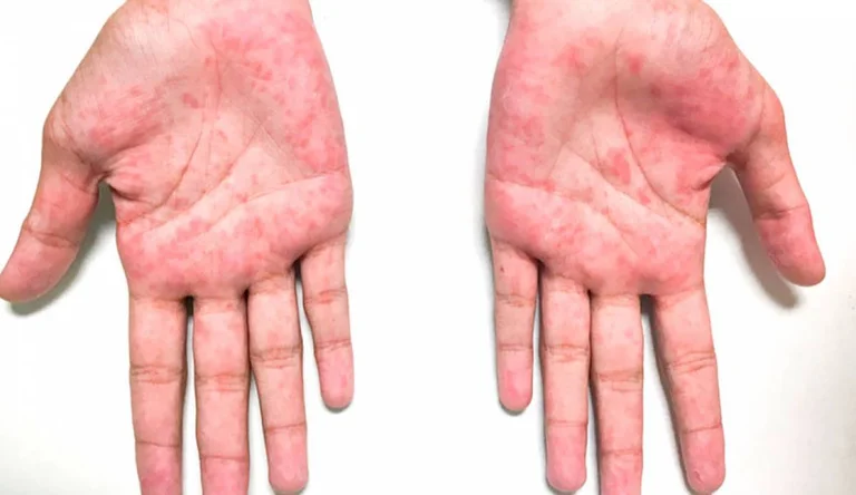 Le syndrome de Kawasaki a déjà affecté des enfants en Serbie
