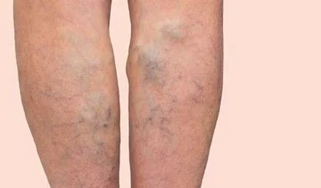 Four Ways to get rid of variable veins