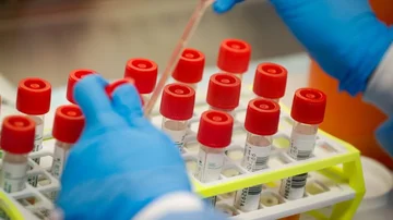 Le sonde contro la malaria aumentano la mortalità del Coronavirus