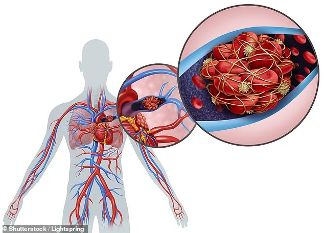 Another study confirms: Coronavirus is causing blood clots