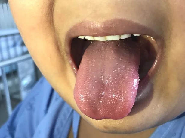 Doctors: Kawasaki disease and new syndrome may be linked to coronary