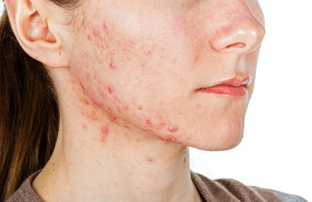 Salva dalle barba rosse; 3 modi efficaci dai dermatologi