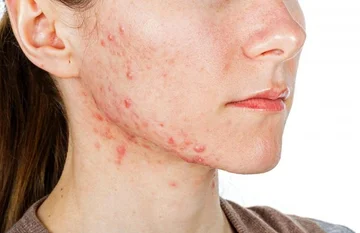 Save from red beards; 3 ways effective by dermatologists