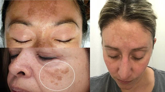 The ideal time for karanin peeling; this miracle soap will remove any brown stain from your skin