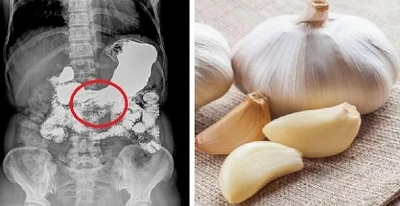 Ein Leidender ist von einem Arzt verboten, Knoblauch zu verwenden