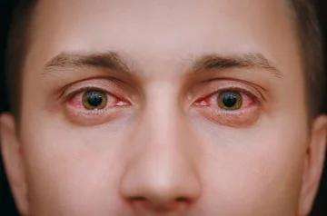 Controlla: Gli occhi rivelano se hai coronary