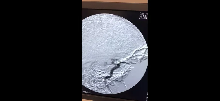 QKUK: Kryhet rasti i parë në Kosovë në stroke center, pacientit i shpëtohet jeta dhe invaliditeti