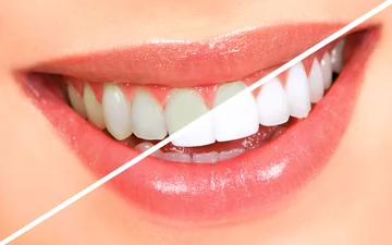 Clear your teeth with just two natural components
