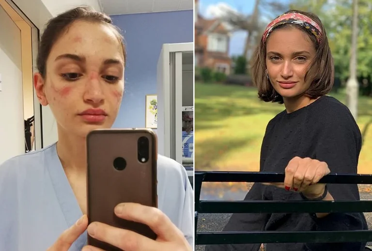 Coronavirus nurse gets frustrated after the mask bruises her face: Stay home, don't be selfish
