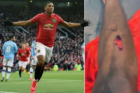 Vista horrible, Martial anotó contra City pero sufrió mucho con su pie
