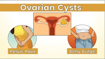 If you have these symptoms, go to your gynecologist immediately, you may have cystems in your ovaries and not know anything.