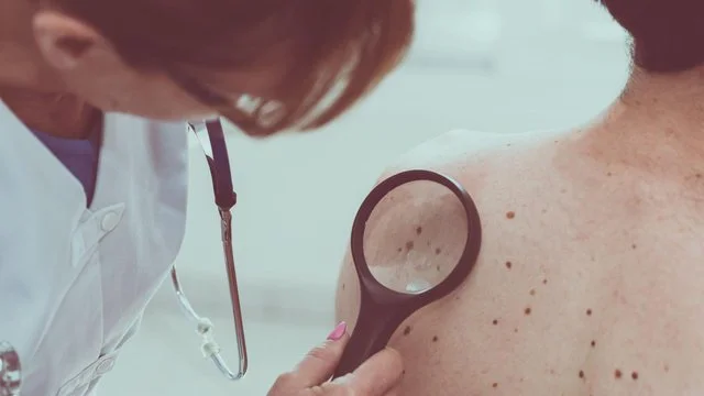 5 Die Regeln nach Dermatologen, um Warnzeichen von Hautkrebs zu entdecken