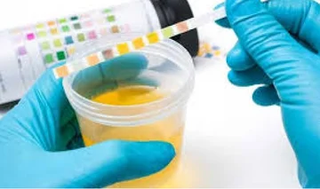 Che colore urinario è un segno di malattie pericolose
