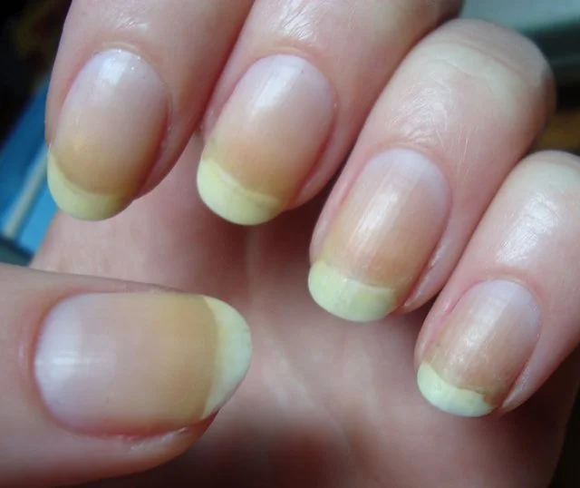 Enough manicure, these are the only 2 methods that whiteen yellow nails in five minutes.