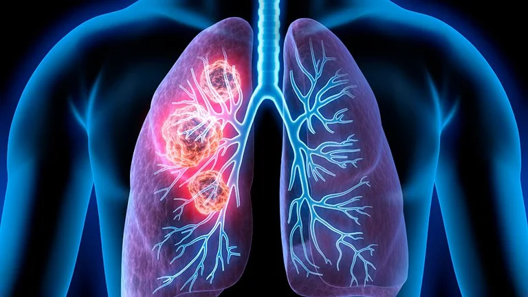 They look harmless: These are the first signs of lung cancer