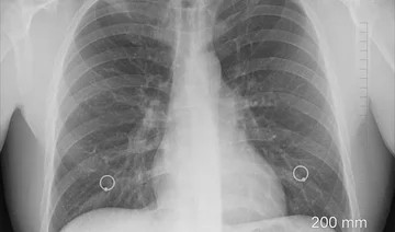 Sembrano innocui: Questi sono i primi segni del cancro polmonare