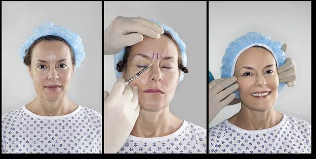When should the botox begin? This is the ideal age for the beginning of injections.