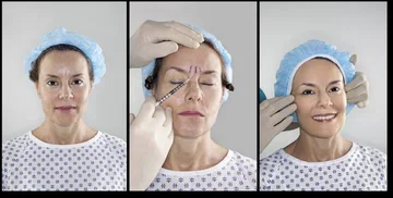 When should the botox begin? This is the ideal age for the beginning of injections.