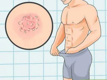You're being threatened by genius herpes, here's the symptoms you show and how you know you're affected.