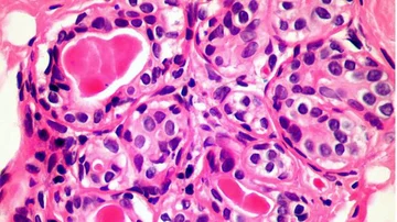 BBC: Gli scienziati possono aver trovato tutta la guarigione del cancro