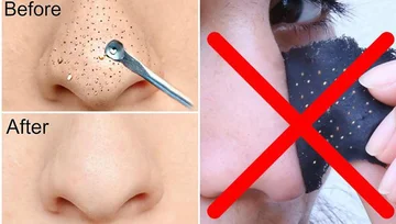 Steps for a peteling procedure at home; The result is the same as going to the clinic