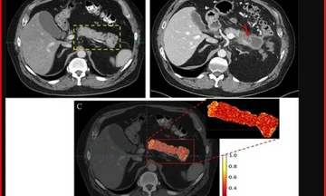 New Test Reveals Pancreatic Cancer Early